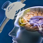 Метод TMS и его обширное применение в неврологии