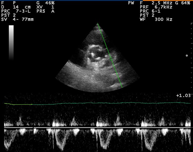 Эхокардиография. Имплантированный искусственный клапан сердца.' src='../images/Pic/EXOKG1.jpg' alt='Эхокардиография. Имплантированный искусственный клапан сердца